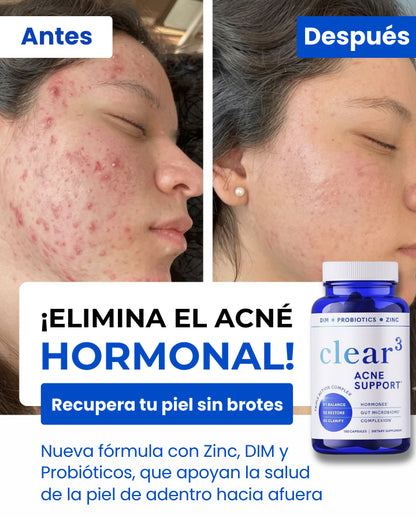 ClearSkin® – Elimina el Acné Hormonal | Piel Limpia, Sana y Equilibrada