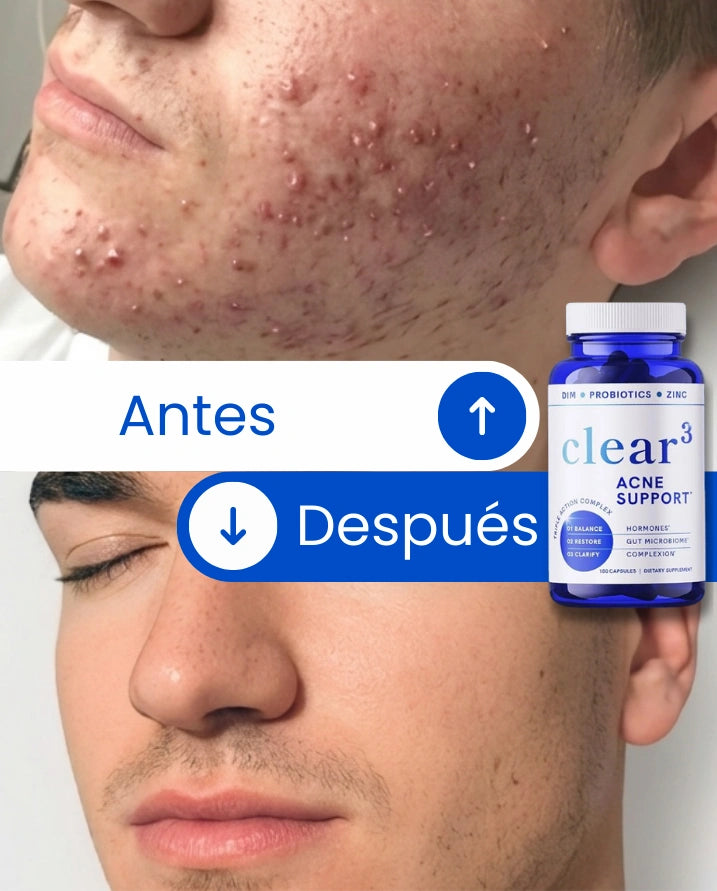 ClearSkin® – Elimina el Acné Hormonal | Piel Limpia, Sana y Equilibrada