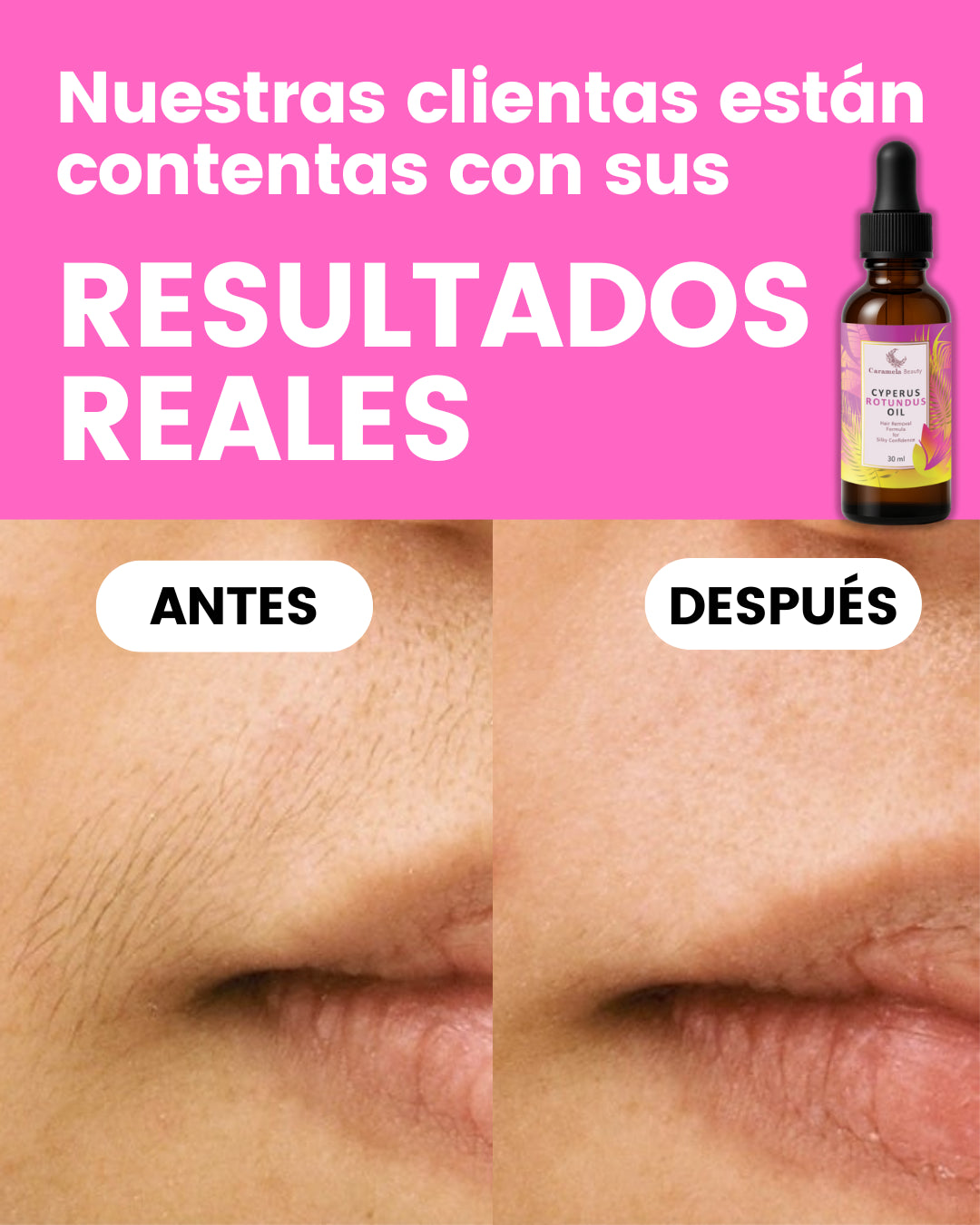 Serum natural 🌿 Reduce el crecimiento del vello corporal ¡YA NO TENDRÁS QUE DEPILARTE!✨