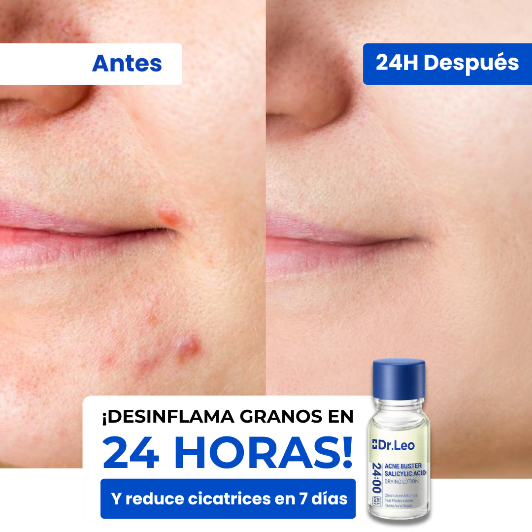Loción Secante Dr. Leo | Desinflama los granos en 24 horas y reduce marcas de acné en 7 días