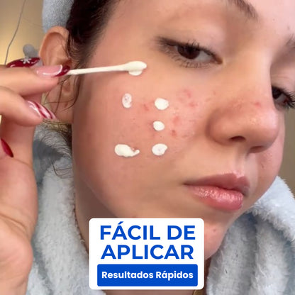 Loción Secante Dr. Leo | Desinflama los granos en 24 horas y reduce marcas de acné en 7 días