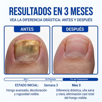 Pack x3 Lápiz Antifúngico para Uñas Amarillas – Combate el Hongo y Vuelve a Mostrar tus Pies sin Vergüenza